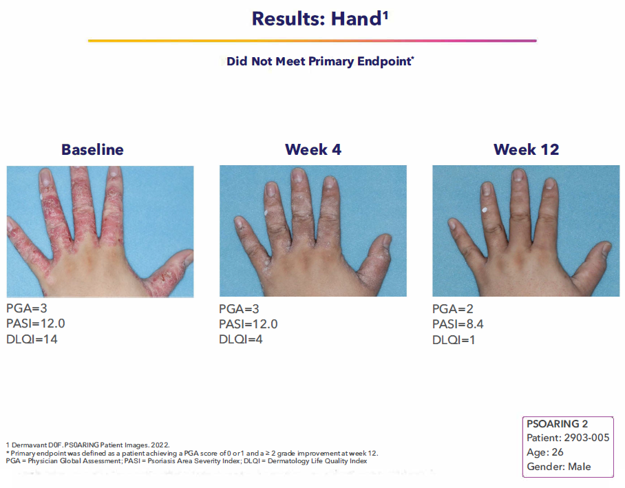 Tapinarof Cream 1% is FDA Approved
